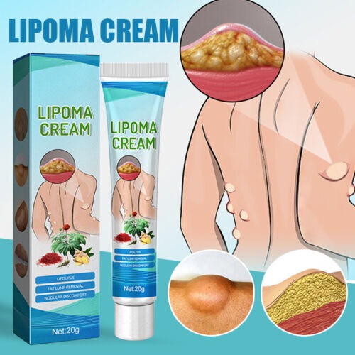 South Moon™ Lipoma Treatment Ointment (20 gm) (3 pic)